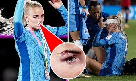 Women’s World Cup Live Updates: Alex Greenwood bloodied in collision with Salma Paralluelo