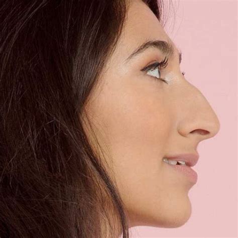 Women with big noses. Rhinophyma is characterised by prominent pores and a fibrous thickening of the nose, sometimes with papules. It is associated with the common skin condition rosacea and it can be classified clinically into 5 grades of increasing severity. Complications. Tissue thickening may come to cause airway obstruction and impede breathing. 