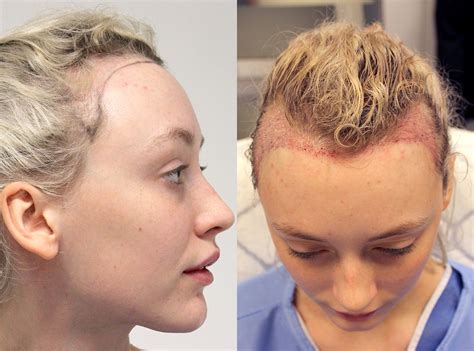 Women with receding hairline. Summary. A receding hairline may occur in both males and females, though is more common in males. There is no cure for a receding hairline. But, medications may help slow it down and encourage... 