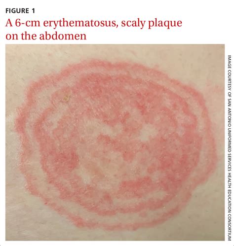 Worsening rash MDedge Family Medicine