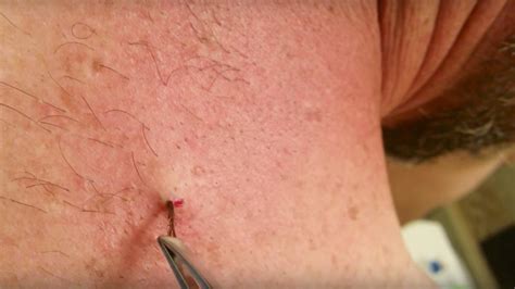 Worst ingrown hair. A hair follicle is the base or root of a hair. The infections can occur ... Symptoms that don't get better, or get worse; Fever; Other new symptoms; A sore ... 