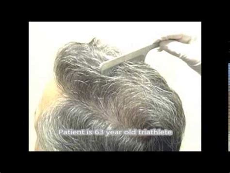 Wow! 63 year old hair transplant result by Dr. Lindsey - YouTube