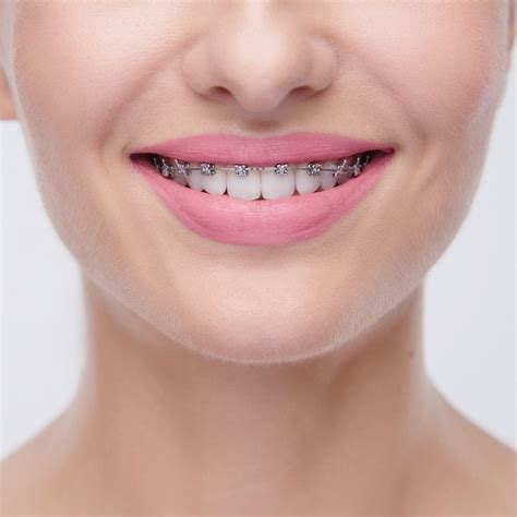 Wow smiles. Your Soledad Orthodontist | Soledad Braces | WOW! Smiles. (844) 900-4969 Patient Portal Dentist Referral Promotions. 