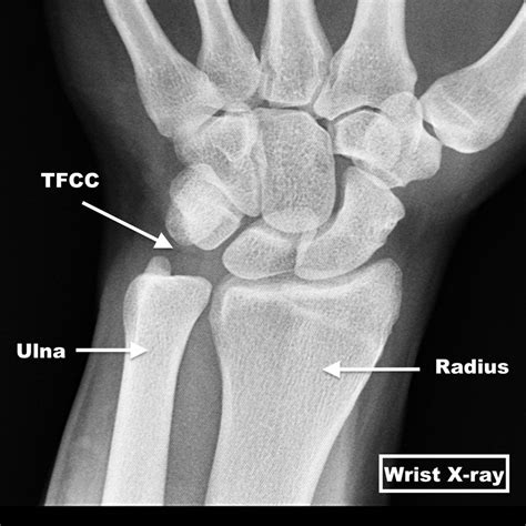 Wrist injury icd 10. Things To Know About Wrist injury icd 10. 