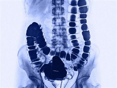 X rays and imaging techniques for ulcerative colitis