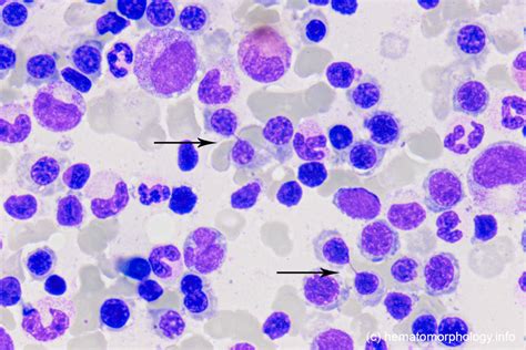 X-linked dyserythropoetic anemia with abnormal platelets and neutropenia