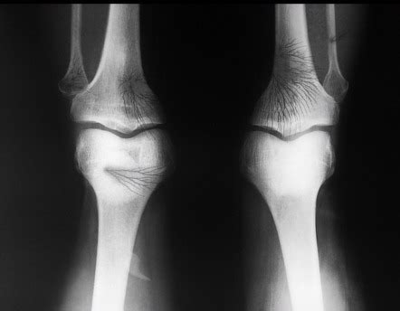 X-ray artifacts Radiology Reference Article