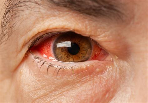 X_redeyes. Dry eye. Eyestrain. Contact lenses. Blepharitis. Takeaway. Itchy eyes can be triggered by allergies, environmental pollutants, infection, and some conditions affecting the eyes. The treatments and ... 