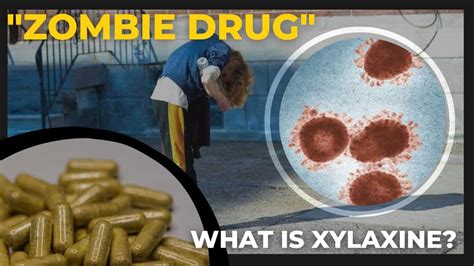 Xylazine, the 'zombie drug,' infiltrating street supply