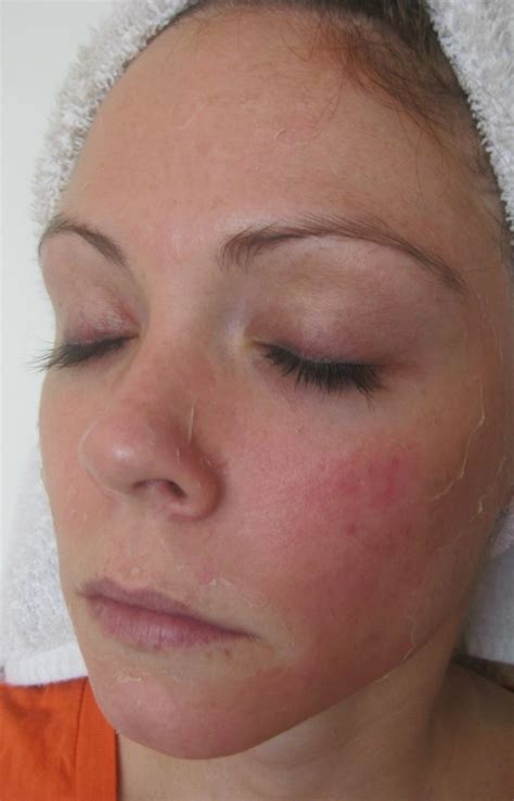 Yüz Kızarıklığı İçin Maske Tarifleri, Hazırlama Şekli ve Faydaları. 