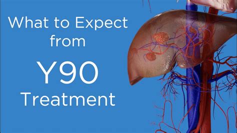 Y90 radioembolization is a minimally invasive procedure that places radioactive beads into a blood vessel near your liver to block your tumor’s blood supply and destroy its cells. Learn about the candidates, success rates, and outlook of this treatment option for liver cancer that can’t be cured with surgery or a liver transplant.. 