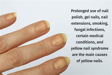 Yellow Nails: Causes & How to Whiten Them Naturally - balustradellc