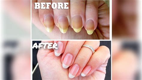 Yellow To White: Nail Cleaning Tips | Nailicy - balustradellc