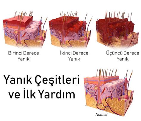 Yanık Çeşitleri, Ciddiyetini Belirleyen Faktörler ve İlk . 
