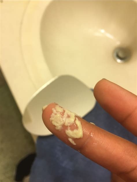 Yeast infection discharge picture. Mar 2, 2023 ... Attaching pic of discharge. Is this yeast infection??? Please confirm. No itching but this kind of discharge inside vagina but panty is dry . 
