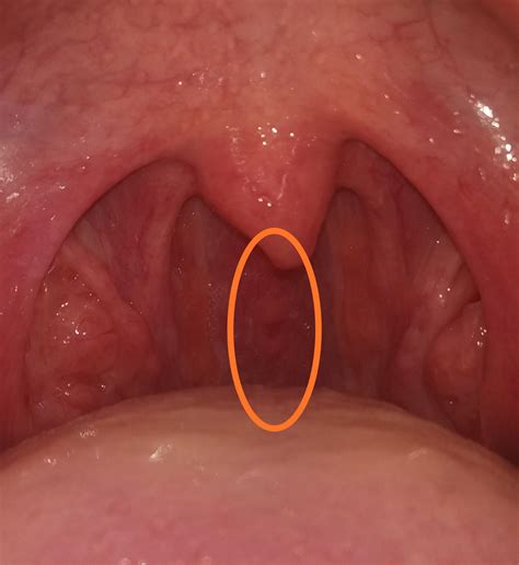 Yellow Bumps On Back Of Throat - I