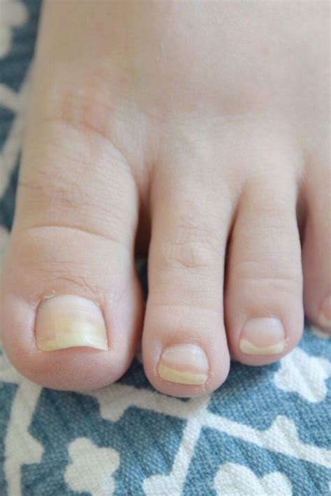 Yellow and Cracked Toenails Healthfully