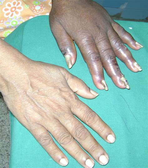 Yellow nails following hemodialysis in chronic renal failure: Is it ...