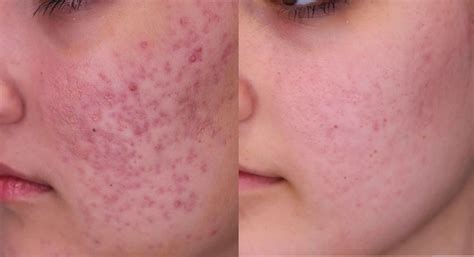 Yes your bright red scars will fade (comparison pictures to