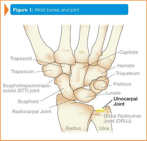 Wrist Fracture. • A break in one of the small bones in the wrist joint or, more commonly, the distal radius . • Symptoms include pain, tenderness, bruising, and swelling. • Treatments include a splint, physical therapy, and surgery. • Involves hand & upper extremity surgery, hand and microsurgery program.
