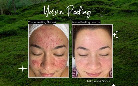 Yosun peeling