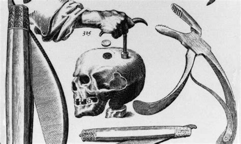 You Need It Like a Hole in the Head: The Ancient Medical Art of …