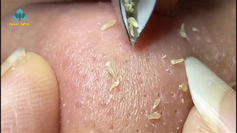 You tube whiteheads. Click here to subscribe to Dr. Pimple Popper: https://www.youtube.com/@DrPimplePopper/Join All Access Memberships here:https://www.youtube.com/channel/UCgrsF... 