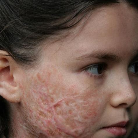 Young black girl scarred by burns. .  <a href=https://lookrussian.ru/d8rwbksu...