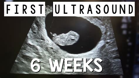 Your 6 Week Ultrasound What You Can Expect to See