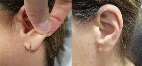 To help your ear with its natural self-cleaning process, Dr. Schwartz recommended over-the-counter ear drops. These tend to be best for those with naturally drier earwax, he said, since they work ...