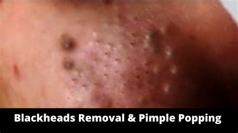 Youtube blackhead popping videos. What’s Poppin Everyone?!?!Welcome back to my channel!!!Today I have another extraction compilation for you all. These are some of my top favorite pops of lar... 