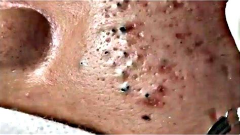 This is a video on squeezing out the blackheads
