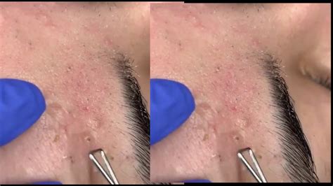 Youtube pimple extraction. how to skincarepopping big pimplescystic acne removal close updilated pore of winer pimple popper blackhead on facewhiteheads around noseblackhead whiteheads... 