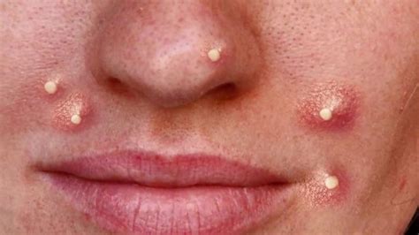 Youtube pimples and blackheads. Things To Know About Youtube pimples and blackheads. 