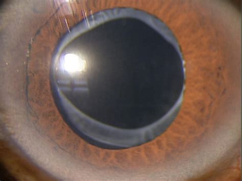 Z96.1 Presence of Intraocular Lens - Deci…