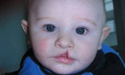 Zajecza warga u dzieci. .  <a href=https://tables.gravitezero.net/assets/imag...