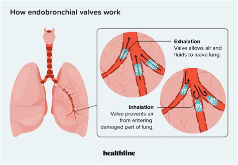 Zephyr Valve for COPD Purpose Benefits Risks and Procedure