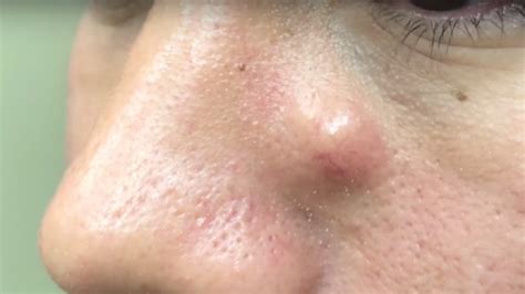 Massive Big Blackheads on Nose Full Official Extraction New 2021 Video. 