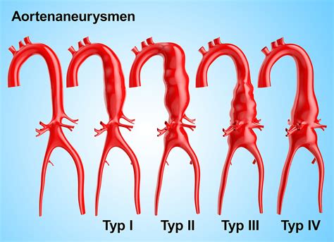 Zur statistik der aneurysmen, besonders der aorta aneurysmen, sowie ©ơber die ursachen derselben. - Nec dt 300 series user guide.