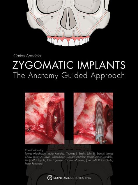 Zygomatic implants the anatomy guided approach. - Oxford handbook of clinical specialties judith collier.