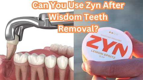 Zyn After Wisdom Teeth Removal: A Quick Guide to Safe and Effective Pain Relief