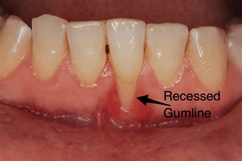 Zyn Gum Recession: The Silent Gum Disease Epidemic