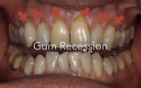 Zyn gum recession. Gum recession is when your gum tissue pulls away from your teeth, exposing the roots underneath. It’s caused by a number of factors, including aggressive brushing, smoking and even genetics. Treatments include antibiotics, antimicrobial mouth rinses and surgery. Gum recession can’t be reversed, but treatment can prevent it from getting worse. 