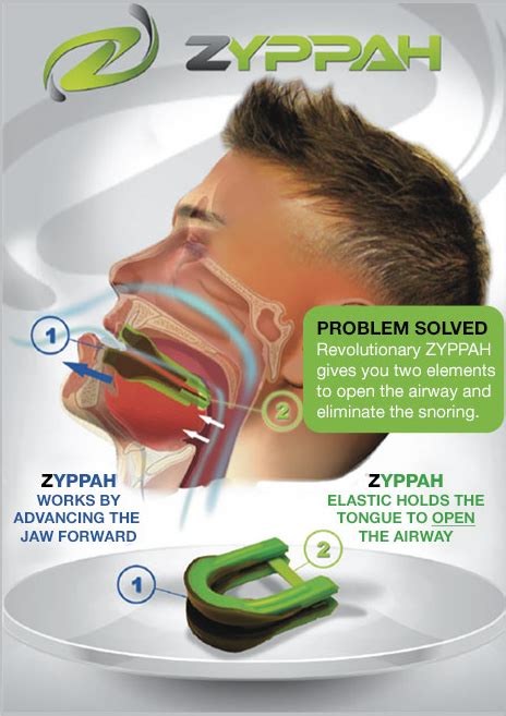 Zyppah Snore Aid - What You Need to Know