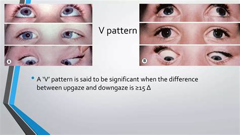 A And V Pattern Strabismus