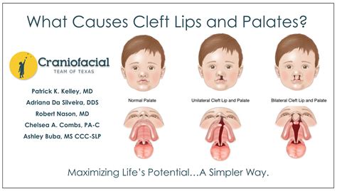 A Cleft Palate Arises When The Right And Left
