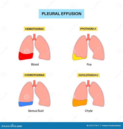 A Pleural Effusion Is Most Accurately Defined As