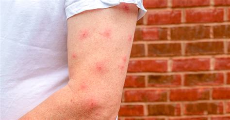 A Small Mosquito Bite Causes Big Trouble Reading Core Bites 6th Grade - Core Bites 6th Grade