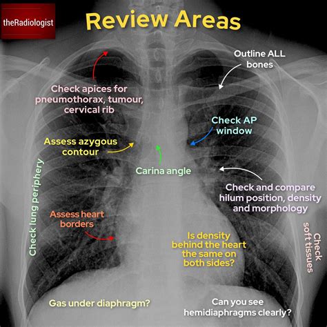 Abc Chest X Ray
