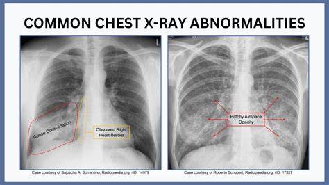 Abnormal Chest X Ray
